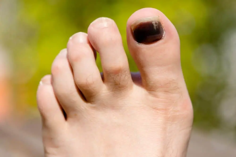 black toenail due to feet sliding in hiking boots