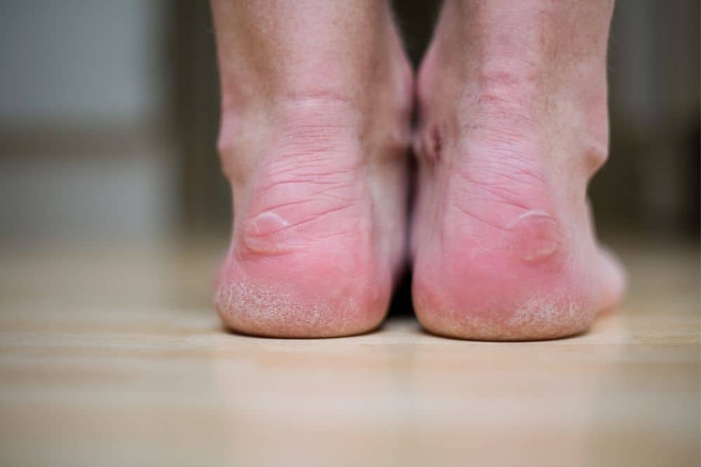 blisters on heels