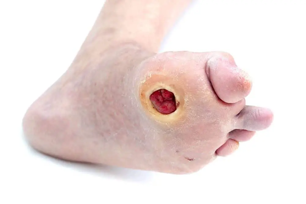 foot ulcer