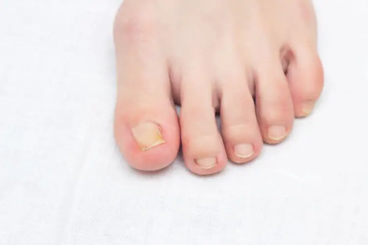 woman foot with ingrown toenail