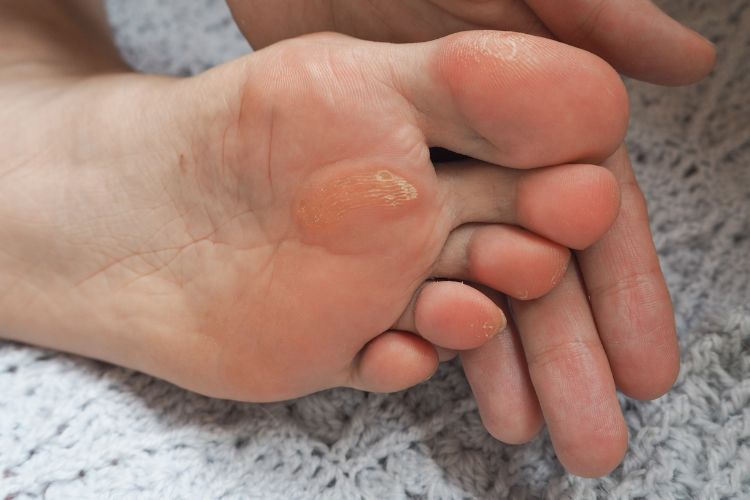 Calluses on foot